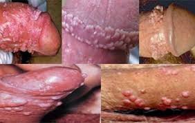 Jual Obat Sipilis De Nature Pengiriman ke Sukoharjo