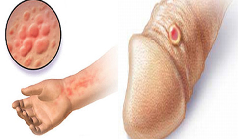 Jual Obat Sipilis De Nature Pengiriman ke Sumba Timur