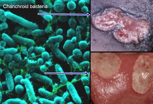 Jual Obat Sipilis De Nature Pengiriman ke Sambas